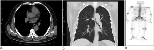 Figure 2. Chest CT: no tumor in the lungs and pleura (a) transverse view and (b) coronal view). (c) Whole body bone scan: no bone metastasis.