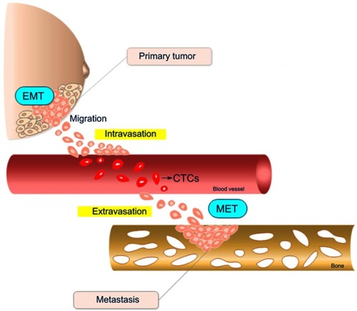 Figure 1 Schematic representation of the metastatic cascade steps in breast tumors. Cells in the primary tumor undergo epithelial-mesenchymal transition (EMT), acquiring migratory and invasive properties. After leaving the primary tumor, cells enter into circulatory or lymphatic vessels until extravasation to a distant metastatic secondary site represented in the scheme by a bone. Once established at the secondary site, cells suffer an inverse EMT process called mesenchymal-epithelial transition (MET). The drawing has no anatomical proportions.