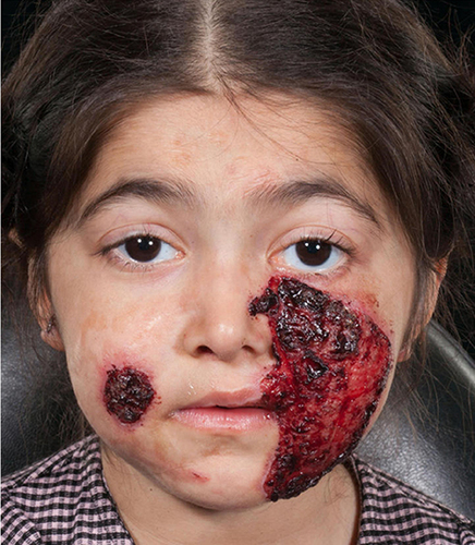 Figure 6 Chronic facial wound in a child with LOC syndrome.