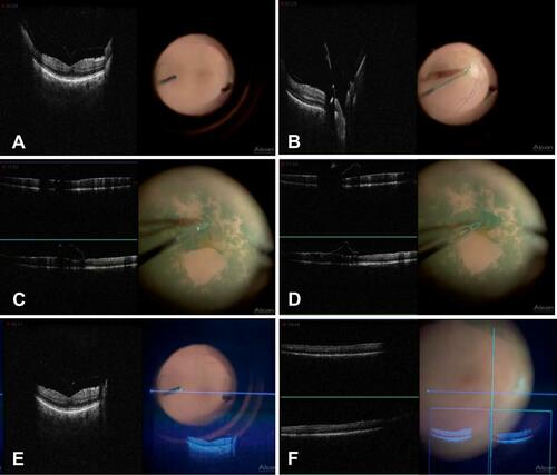 Figure 1 Screen grabs from a left eye live video demonstrating simultaneous same screen iOCT viewing with the Haag Streit (gen 2) iOCT side by side with the live surgical field during a membrane peel in a patient with vitreomacular traction and ERM. (A) Vitreomacular traction at fovea, (B) Posterior hyaloid attached at optic nerve, C-D) Membrane peel, (E) Vitreomacular traction at fovea with OCT image injection, (F) Macula following membrane peel with OCT image injection.
