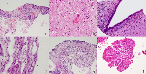 Figure 3. Histopathological findings (a) Subarachnoid hemorrhage, (b) Parenchymal microhemorrhage with anoxic neurons, (c) Periventricular area with germinal matrix with congestion, (d) Meningitis, (e) Cerebellum and (f) Choroid plexus hemorrhage.