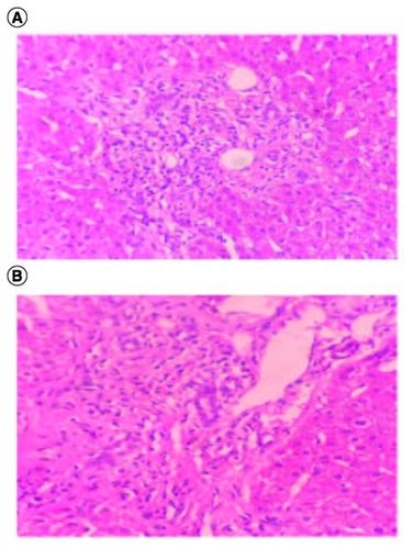 Figure 2. (A & B) Lymphocytic infiltration targeting the bile ducts associated to biliary neocanals with ductopenia; hematoxylin-eosin ×100.