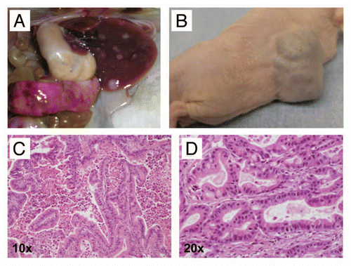 Figure 5 A minority of CB mice develop invasive and metastatic PDAC at relatively long latency (15 months or greater). (A) Example of a metastatic PDAC arising in a 24-month-old CB mouse. Multiple metastatic lesions in liver and spleen are readily visible. (B) Serial transplantation of tumor tissue into athymic mice resulted in growth as subcutaneous xenografts, a property of cancer cells. (C) Histologically, the primary and metastatic tumors were comprised of moderately differentiated PDAC (H&E stain, 10× magnification). (D) Moderately differentiated PDAC, at a higher magnification (H&E stain, 20× magnification). Note mucin vacuoles within neoplastic glands.