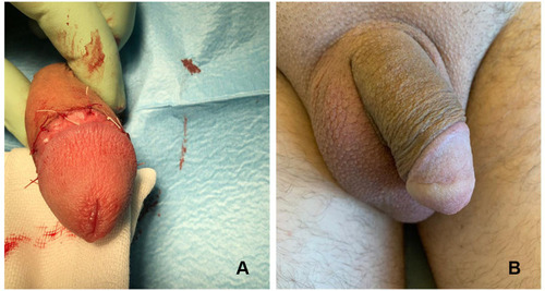 Figure 2 (A) Postoperative wound after CO2 laser circumcision. (B) Postoperative wound at 1 month after CO2 laser circumcision.