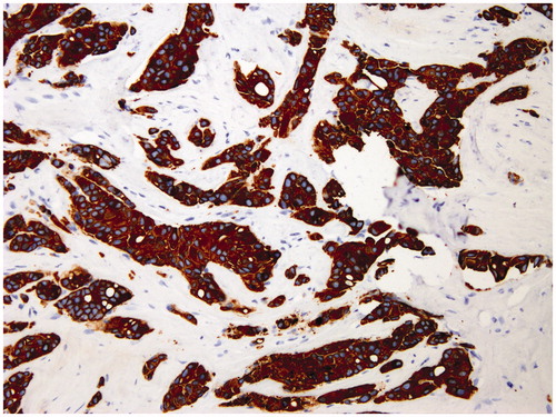 Figure 1. Monoclonal antibody staining for cytokeratin 19 in large-core needle biopsy of breast carcinoma obtained for diagnosis. Note the intense diffuse staining at membrane and intracytoplasmic level in 100% of tumor cells.