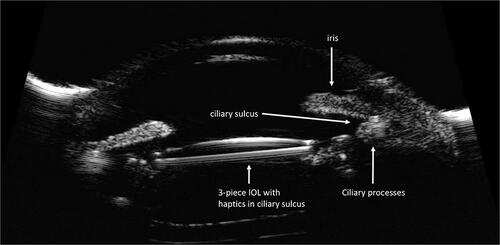 Figure 2 High-frequency ultrasound biomicroscopic image demonstrating a well positioned 3-piece intraocular lens in the ciliary sulcus space.