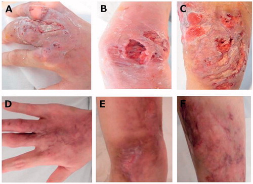 Figure 1. Gross appearance of the skin ulcers: the dorsum of the right hand (A), left wrist (B) and left lower leg (C) on admission. The dorsum of the right hand (D), left wrist (E) and left lower leg (F) demonstrating complete regression after treatment with 10 mg oral PSL and oral tacrolimus on day 78 after admission.