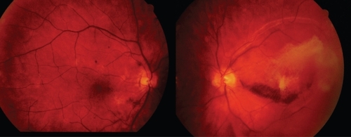 Figure 2 Fundus photograph of OD (left) and LE (right) showing the resolution of retinal and vitreous hemorrhages in both eyes.