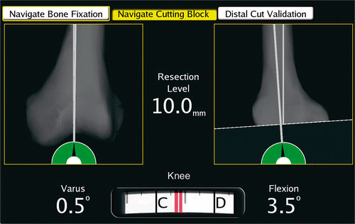 Figure 3. Sample screenshot from the Zimmer CAS system providing guidance regarding the positioning and sizing of the femoral cutting guide to achieve the desired result. (Image courtesy of Zimmer CAS.)