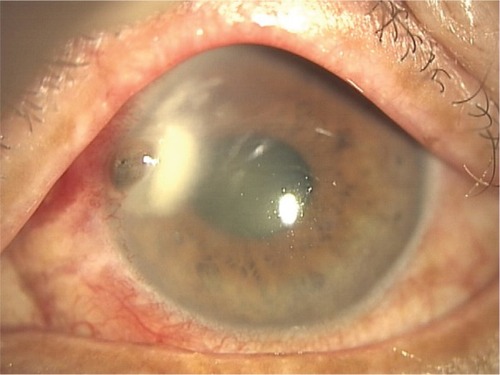 Figure 4 Case 5 (the anterior picture at the initial visit).