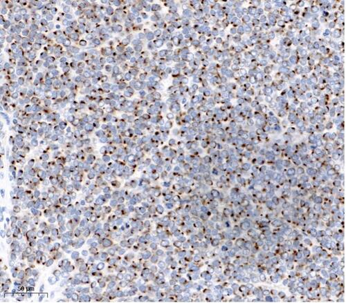 Figure 4 Cytokeratin-20 immunohistochemical staining shows a paranuclear dot pattern (original magnification: X200).