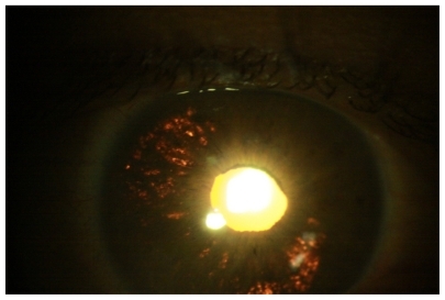 Figure 1 Transillumination defects of the right eye at 2 weeks.