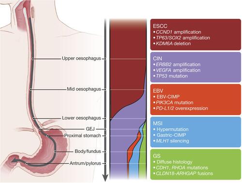 Figure 1 The four molecular subtypes of esophagogastric cancer described in the TCGA study, their mutational patterns, and location. Note:Reproduced from Cancer Genome Atlas Research Network. Integrated genomic characterization of oesophageal carcinoma. Nature. 2017;541(7636):169. doi:10.1038/nature20805.Citation16