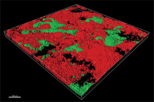 Figure 3. Confocal image (viability staining) of plaque biofilm treated with a combination of chlorhexidine and an antimicrobial peptide. Red areas indicate killed microbes, and green areas indicate viable microbes.