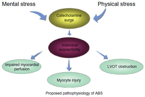 Figure 4 Proposed pathophysiology of apical ballooning syndrome (ABS).