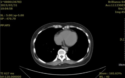 Figure 3 Pericardial effusion-volume changes seen on a computed tomography scan obtained on March 31, 2015 (4 months after bevacizumab treatment).