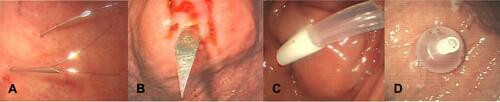 Figure 2 The procedure of percutaneous endoscopic gastrostomy (PEG) insertion by the introducer method. (A) Fixing the stomach and abdominal wall with a gastropexy device. (B) Insertion of the special trocar. (C) Insertion of a balloon feeding tube. (D) Internal fixation was completed by water injection.