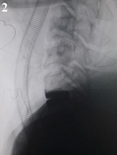 Figure 2 Intraoperative fluoroscopy. A prosthesis cervical disc device was implanted at C6–C7.