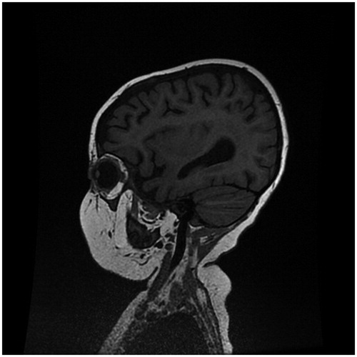 Figure 1. MRI performed in January 2018 revealed signs of decreased brain volume and wider sulci.
