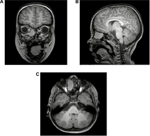 Figure 2 Magnetic resonance imaging (MRI) of patient demonstrating large ethmoidal mucocele on the right.