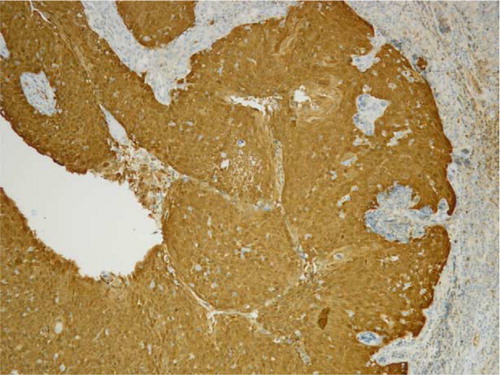Fig. 1 p16+ immunohistochemistry staining (>75% positive brown coloured cells) on oropharyngeal squamous cell carcinoma (OPSCC) section.