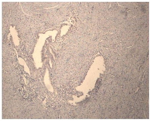 Figure 8 Cox-2 negative expression in a patient using Mirena® who had been previously submitted to an endometrial resection.