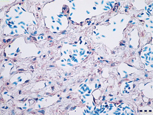 Figure 6. Myosin weak cytoplasmic positivity (brown) in neoplastic smooth muscle cells of the angiolipoleiomyoma. Immunohistochemistry, diamino-benzidine–chromogen. Bar: 20 µm.