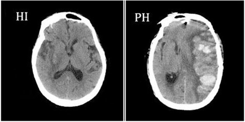 Figure 1 Hemorrhagic infarction and parenchymal hemorrhage CT scan examples of hemorrhagic infarction (HI) and parenchymal hemorrhage (PH), according to the European Cooperative Acute Stroke Study II classificationCitation28.