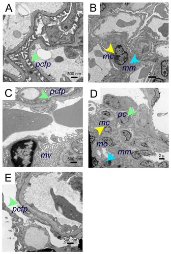 Figure 4 Electron microscopy images of morphine-induced glomerular alterations in BERK-sickle mice. Electron micrographs of kidneys from BERK mice treated with PBS or morphine for 3 weeks. (A and B) Electron micrographs of kidneys from PBS-treated BERK mice. (A) Normal podocyte foot processes (green arrow) and (B), normal mesangial region (mesangial cell, yellow arrow and mesangial matrix, turquoise arrow) in male BERK mice treated with PBS. (C–E) Electron micrographs of BERK mice treated with morphine for 3 weeks. (C) Foot process effacement (green arrow) and marked microvillus (mv) transformation in the kidney of female BERK mice treated with morphine. (D) Marked expansion of mesangial matrix (turquoise arrow), podocyte (green arrow), and increased mesangial cells (yellow arrow), but no immune complexes in the kidneys of male BERK mice treated with morphine. (E) Foot process effacement (green arrow) in the kidney of male BERK mice.