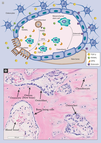 Figure 2.  Bone remodeling process.(A) Signals involved in bone remodeling and the role of mesenchymal stem cells (MSCs) in these processes. MSCs are precursors of osteoblasts (black arrow). The process of osteoblastogenesis is inhibited by sclerostin produced by osteocytes. In concert with osteocytes, MSCs also control osteoclastogenesis via the production of RANKL and OPG (blue arrow). In OA, osteoclasts release TGF-β from the bone matrix, which modulates MSC activity near the resorption site. (B) Bone remodeling activity in OA subchondral bone (hematoxylin and eosin staining of EDTA-decalcified femoral head subchondral bone). OA: Osteoarthritis.