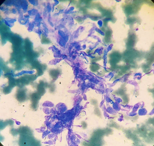 Figure 3 Under 100X magnifications, shows a hemorrhagic background containing a cohesive cluster of slender spindle cells exhibiting mild to moderate pleomorphism along with small mature lymphocytes and plasma cells at the background set in pinkish stroma.