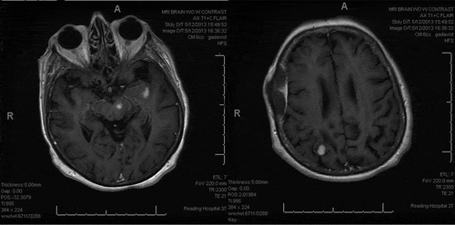 Figure 1. (a,b) Three enhancing solid mass lesions within the left insula, left midbrain-thalamus, and right parietal lobe with mild increased T2 signal with mild adjacent vasogenic edema. Focal meningeal thickening along the right lateral frontal temporal bone possibly secondary to a granulomatous process given the patient’s history of Churg-Strauss syndrome