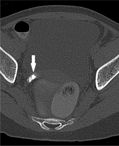 Figure 2 Axial computed tomography scan (bone window) image showing oval calcification (arrow) in the right adnexa.