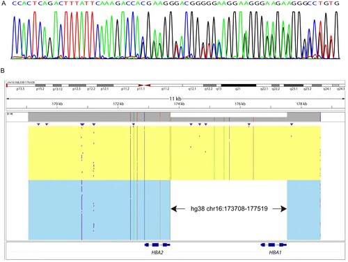 Figure 2. Sequencing analysis of the -α3.7III deletion. (A) Sanger sequencing results of -α3.7III in the proband. (B) SMRT analysis of the patient. The light yellow and blue regions indicate the two alleles of the α-globin gene cluster. The arrows show the region of the deletion. The purple dots indicate sequencing errors. The relative positions of the HBA2 and HBA1 genes on chromosome 16 are indicated by blue boxes. The vertical colored lines indicate nucleotides A (green), T (red), C (blue) and G (orange) discordant with alignment to hg38 reference sequence.