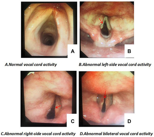 Figure 1 The vocal cords after recurrent laryngeal nerve injury.
