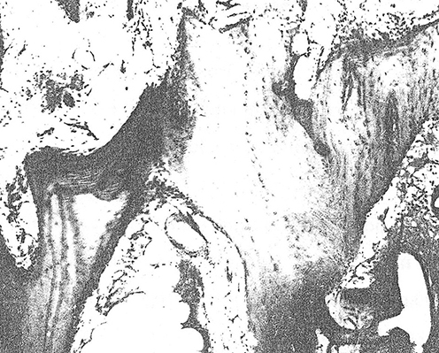 Figure 2 Microphotograph. Dystrophic changes and necrosis of bone tissue. Haematoxylin and eosin staining. x120.