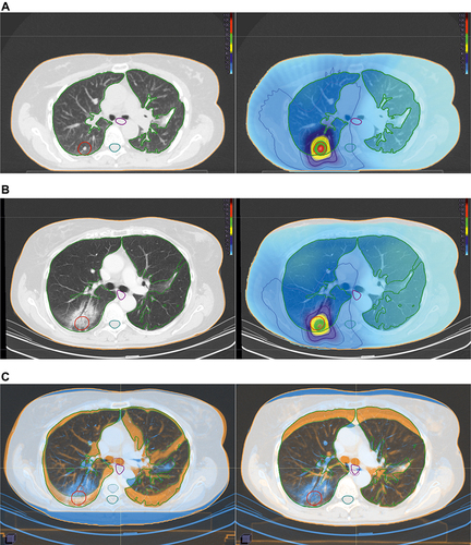 Figure 1 Radiation pneumonitis after SBRT. (A left): 74-year-old female patient treated with SBRT for lung metastasis of parathyroid carcinoma (within the red contour). Planning target volume (red contour) and organs at risk: Total lung (green), spinal cord (turquoise), oesophagus (violet). (A right): Treatment plan (VMAT-technology, 15 Gy in 3 fractions, total dose 45.0 Gy): Isodose lines (% of total dose) and the dose distribution, high-dose region surrounding the tumour (red, green), step down gradient (yellow, dark blue), and a large low-dose region highlighted in blue. (B left): Ground-glass opacities after SBRT, suspected radiation pneumonitis. (B right): A deformable image registration was used to correlate the lung changes on follow-up CT-scan with radiation dose distribution. The changes are conformal to the high- and mid-dose region. (C): A pre-treatment image (orange, dashed lines) and a follow-up image (blue, solid lines) were fused. A rigid image registration (left) cannot account for lung volume and tumour position changes on follow-up CT-scans. The images do not correlate with each other. The deformable image registration (right) is more accurate than the rigid registration and the images correlate well with each other.