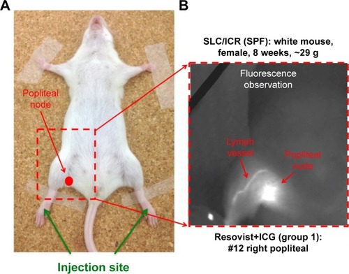 Figure 1 (A) Location of the injection site and right popliteal node. (B) Transcutaneous fluorescence visible using a near-infrared camera after ICG administration.Abbreviation: ICG, indocyanine green.