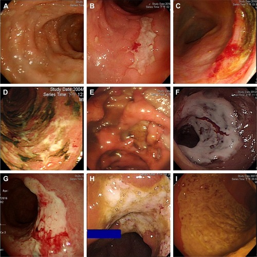 Figure 1 The ulcers of CMV colitis in patients without IBD.