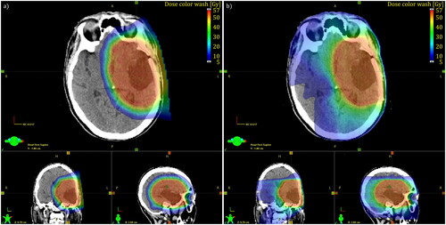 Figure 1. Comparison between PT (left) and VMAT (right) for a patient with glioma. The patient was selected for PT based on lower doses to OARs, and a lower dose to the parts of the brain not including the PTV (brain-PTV); PT 6.7 Gy RBE vs VMAT 15.2 Gy.
