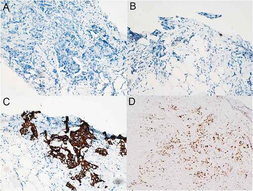 Figure 1. Immunohistochemical results of the primary invasive left breast carcinoma (original magnification, 200×). The tumor stained negative for both ER (A) and PR (B) but strongly positive for HER-2 (C) and exhibited a Ki-67 proliferation index of 20% (D) .