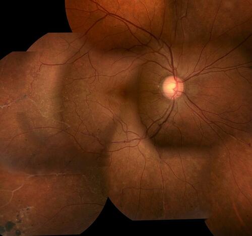 Figure 3 Inactive retinal vasculitis. This patient has 20/20 Snellen acuity with regressed retinal vasculitis with sheathed vessels. Note a chorioretinal atrophic patch with pigment clumps secondary to healed chorioretinitis inferotemporally. There are some collaterals around the temporal vascular arcades indicating compensated retinal ischemia. Such patients need only be observed and counseled for regular follow-ups. Ocular (angiography) or systemic (serologic/radiologic) investigations are not required.