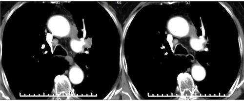 Figure 3 The CT scan results of the changes for target lesions in lymph node of one patient with non-small cell lung cancer before and after the administration of gefitinib plus anlotinib.
