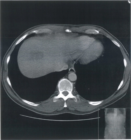 Figure 2 Computed tomography scan of the abdomen with contrast showing an abscess in the dome of the liver.