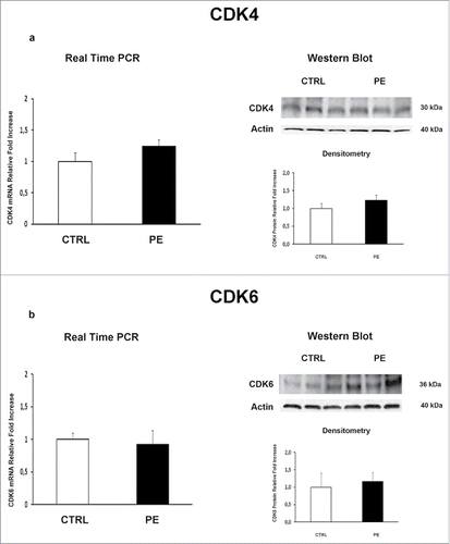 Figure 2. CDK4 and CDK6 gene and protein expression levels in normal vs preeclamptic PDMSCs. (A) mRNA (left panel) and protein (right panel) expression of CDK4 in normal (N, n = 20) and PE-PDMSCs (PE, n = 24) (B) (b) mRNA (left panel) and protein (right panel) expression of CDK6 in normal (N, n = 20) and PE-PDMSCs (PE, n = 24). Statistical significance (*) has been considered as p < 0.05.