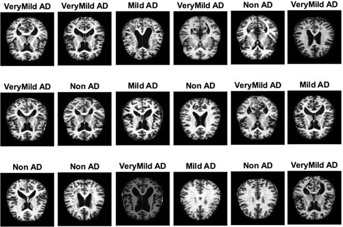 Figure 3. Set of MRI samples after the enhancement method.