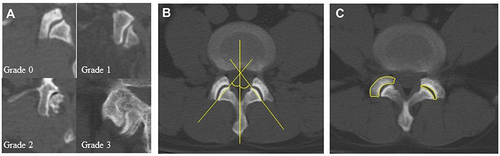 Figure 1 Qualitative and quantitative measurements of the facet joints. (A) Examples of CT-evaluated facet joint osteoarthritis grades. (B) Schema of facet joint orientation measurement. (C) Schema of superior articular process cross-sectional area and facet joint area measurement.