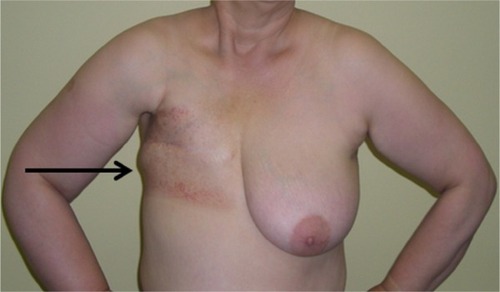 Figure 1 Postradiation changes in the chest wall on the right side.