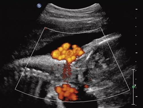 Figure 3 Sagittal imaging of the fetal neck. Power Doppler imaging depicting a quadruple nuchal cord depicted in Figure 2. Note that each of the larger umbilical veins is accompanied by two (smaller caliber) umbilical arteries, respectively.