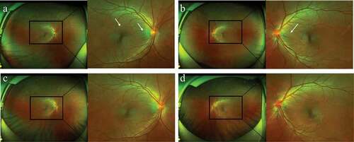 Figure 1. (a–b) Wide-field fundus photographs showed radial retinal wrinkles (white arrows) surrounding the optic disc and fovea OU at presentation (C-D), which disappeared one month after presentation.